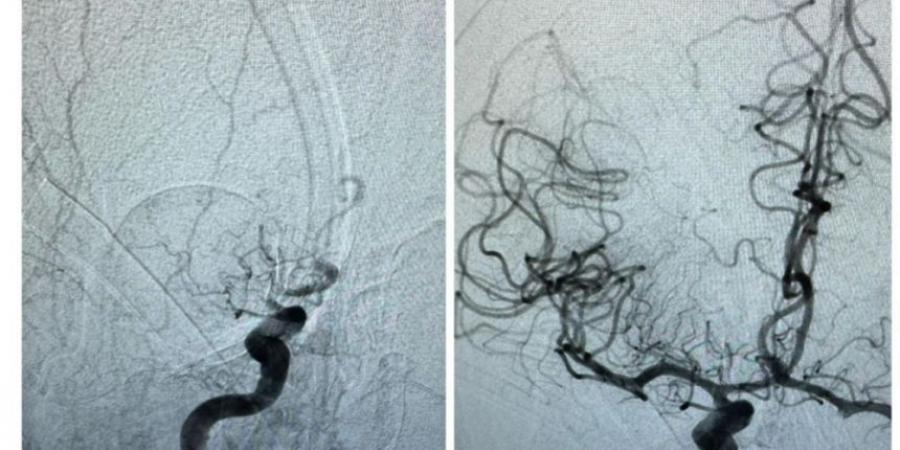 في شهرين.. 52 عملية أشعة تداخلية لعلاج الجلطات الدماغية بعنيزة - الخبر اليمني